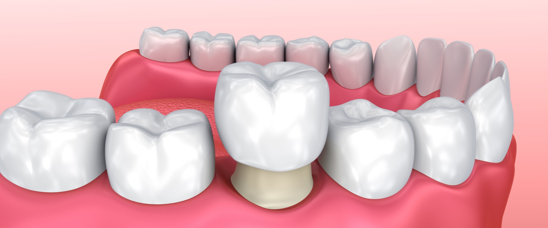 The Different Materials Used for Dental Crowns