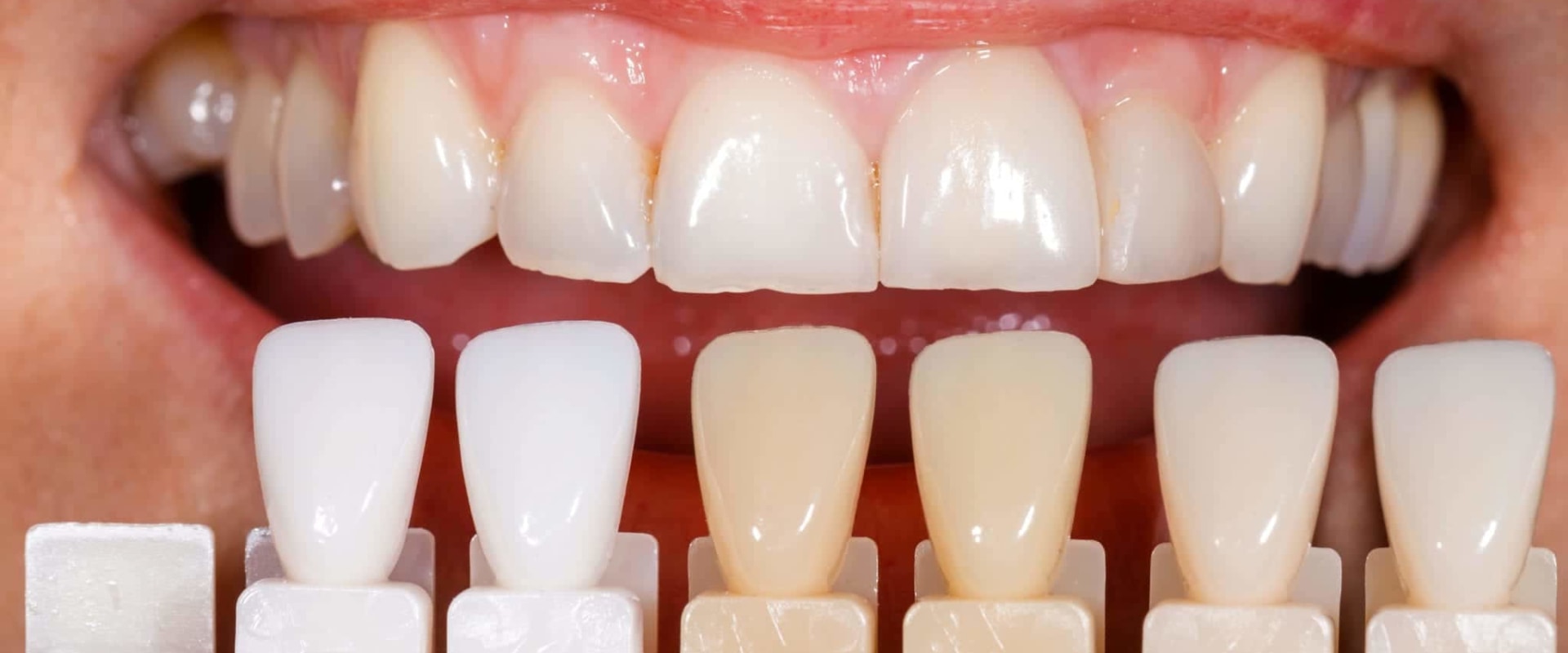 Whitening Discolored Teeth: A Guide to Restoring Your Smile