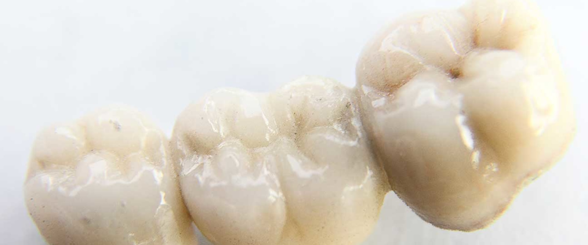 The Beauty and Benefits of Traditional Bridges for Dental Crowns