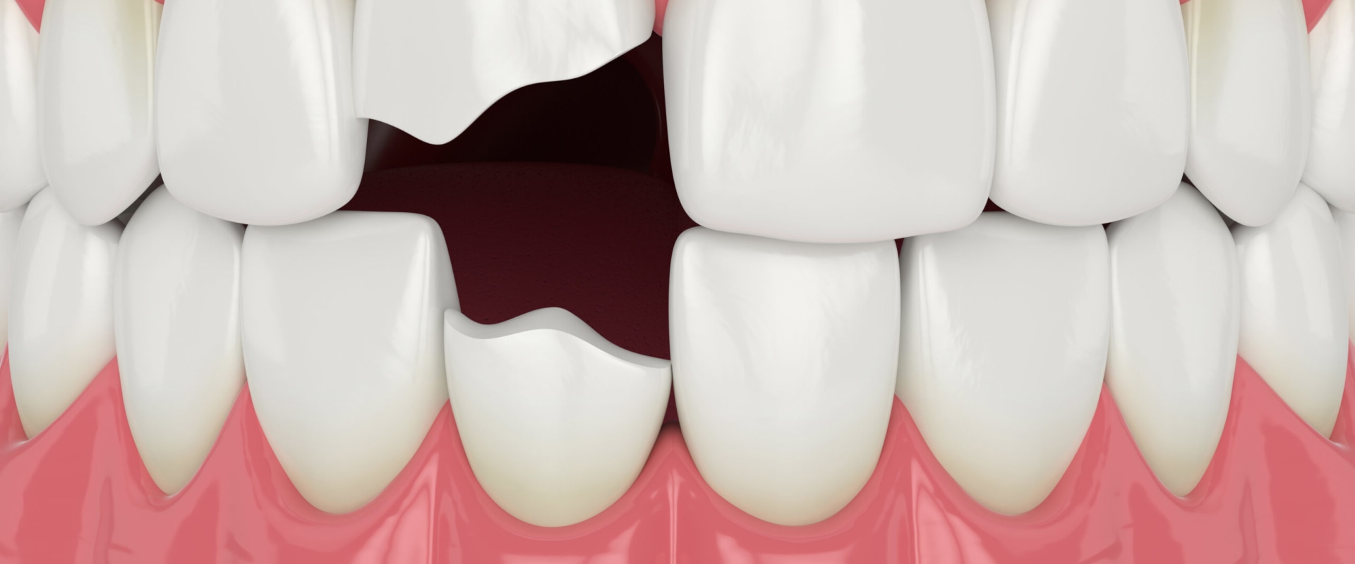Broken Tooth Repair: Everything You Need to Know