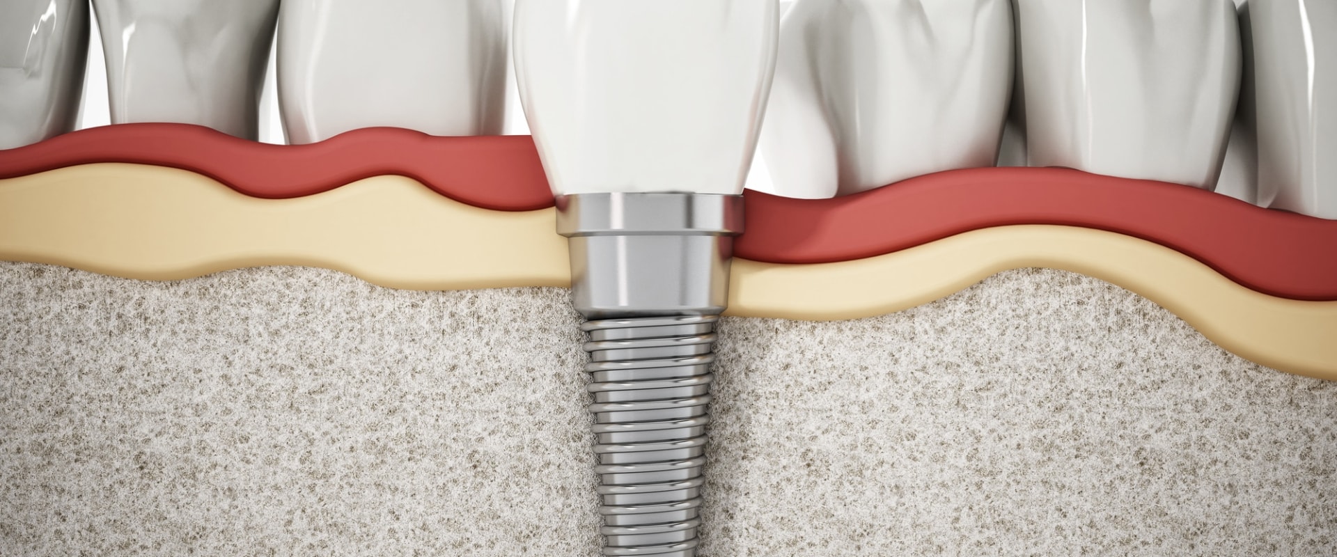 The Long-Term Success of Dental Implants: What You Need to Know
