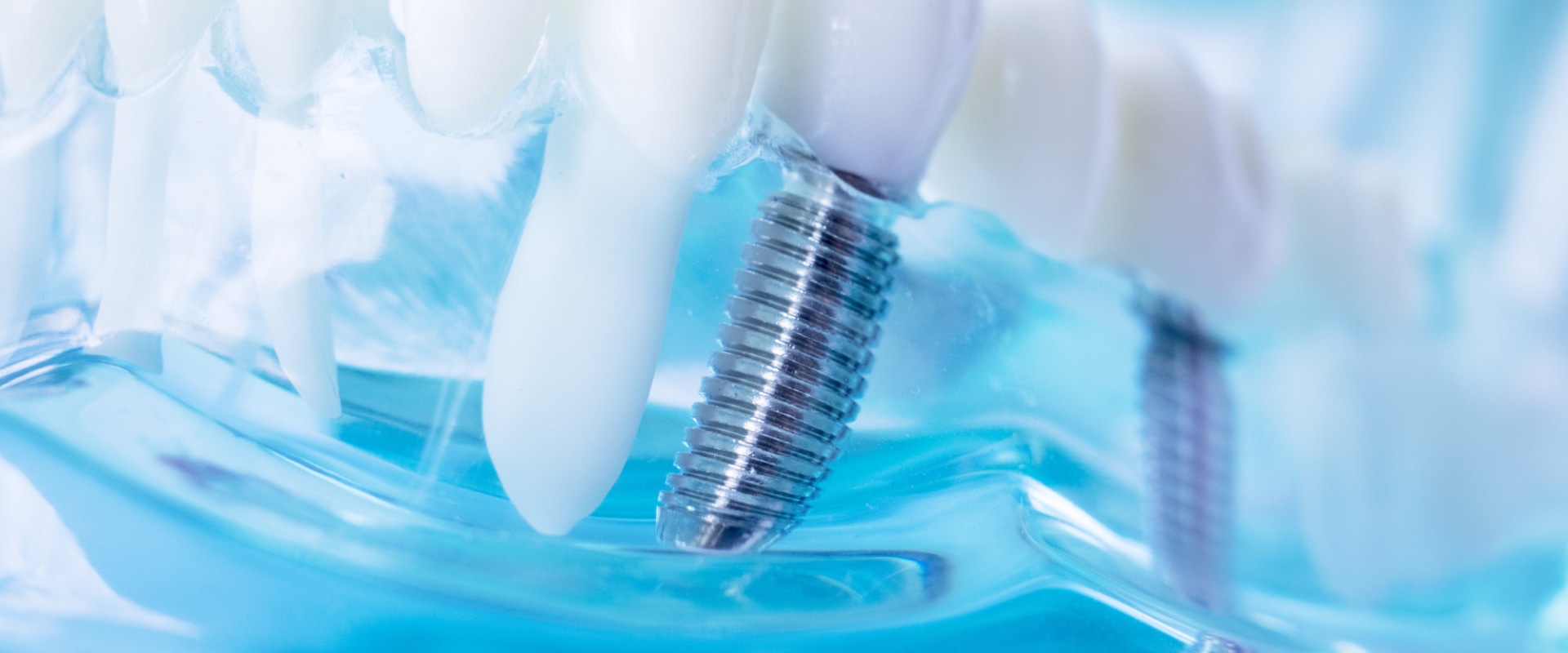 Oral Hygiene Practices with Implants: A Guide to Aftercare and Maintenance