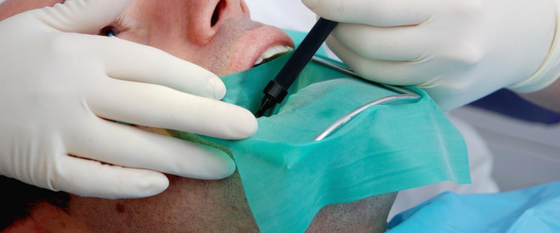 Understanding Root Canals: A Comprehensive Guide to Dental Procedures