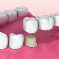 Understanding the Potential Complications of Dental Crowns and Bridges