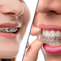 The Truth about the Effectiveness and Duration of Treatment for Invisalign and Braces
