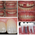 Replacing Missing Teeth: Restoring Your Smile and Confidence