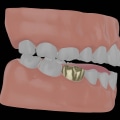 Exploring the Benefits of Dental Crowns