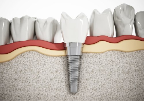 The Long-Term Success of Dental Implants: What You Need to Know