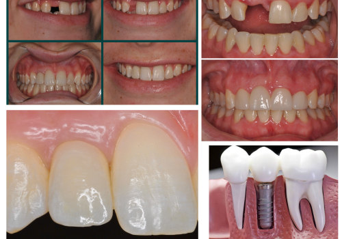 Replacing Missing Teeth: Restoring Your Smile and Confidence