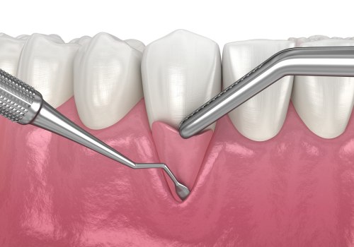 All You Need to Know About Gum Surgery